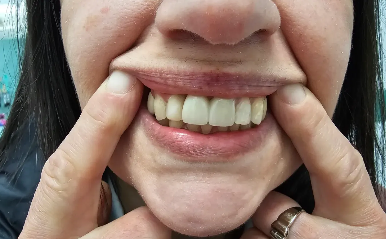 Tooth replacement after treatment