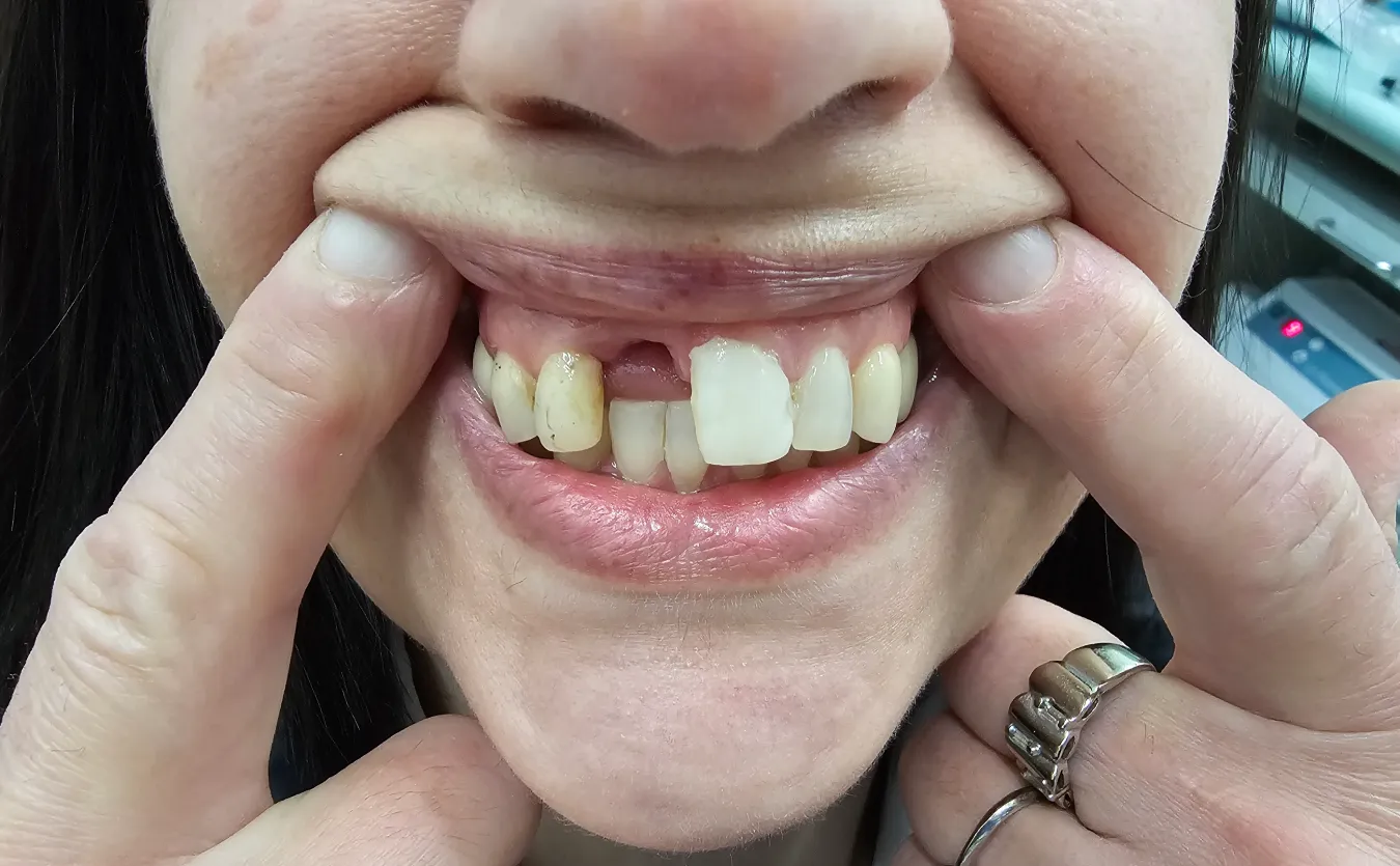 Tooth before treatment